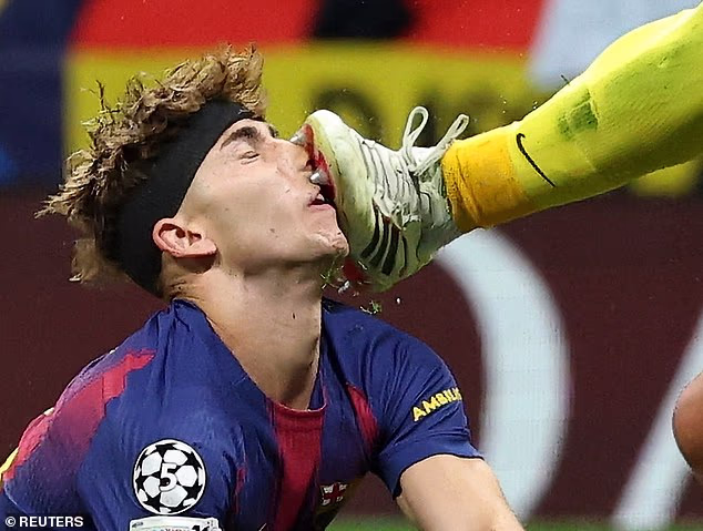 La stella del Barcellona è rimasta sanguinante in campo in scene raccapriccianti dopo essere stata presa a calci in faccia dal portiere dell’Atletico Madrid nella drammatica gara di ritorno della Champions League